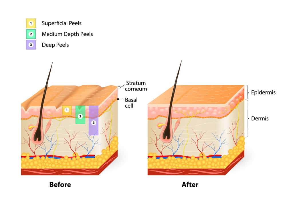 6056c3971460d1115e0edbcf_figure-illustration-corrective-chemical-skin-peels_1024