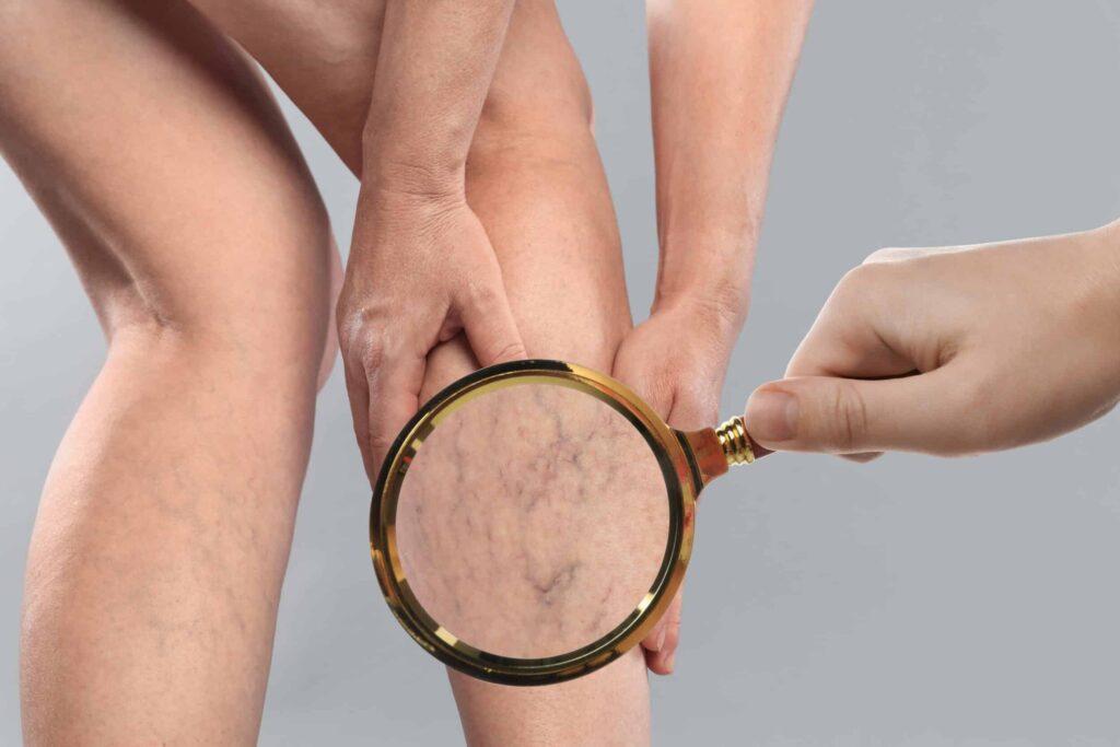 Close up of a patient's leg with a magnifying glass showing their enlarged veins