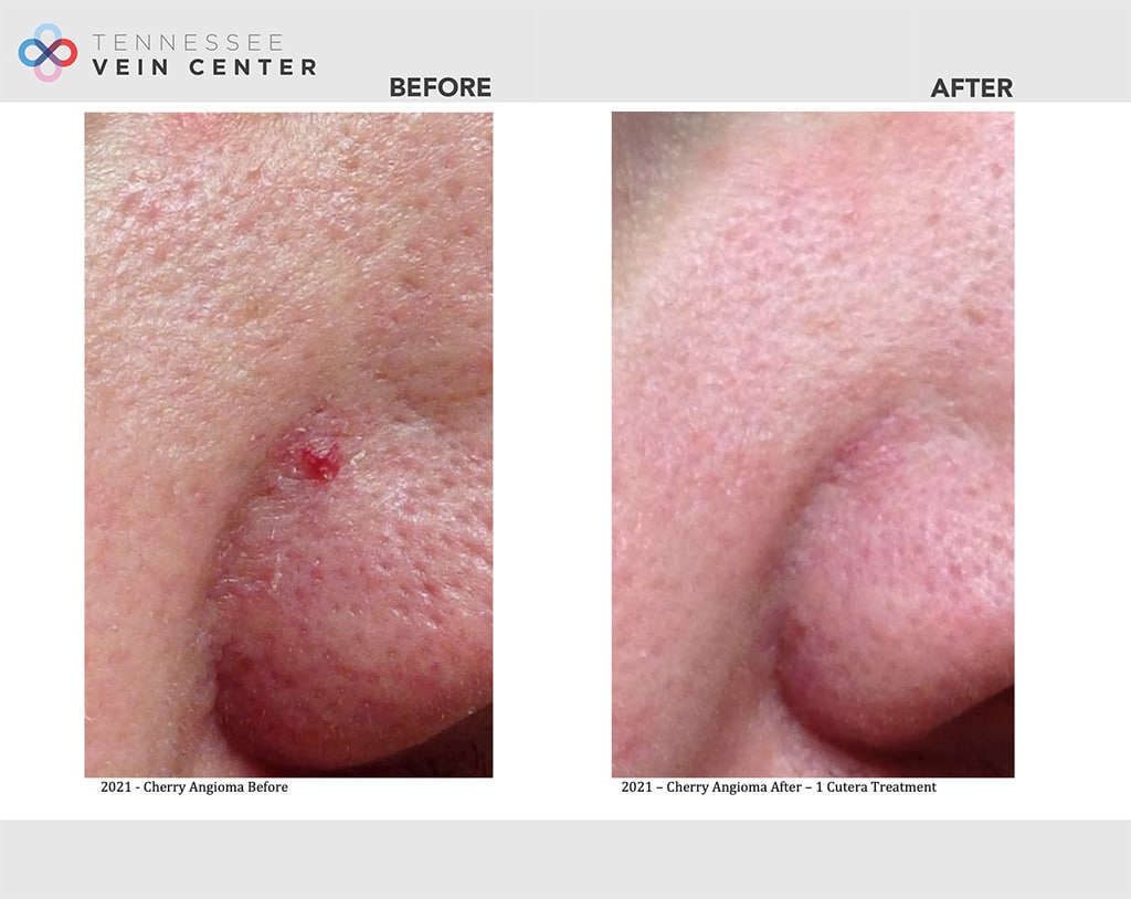 Before & After Image of Cherry Angioma Treatment Maryville TN