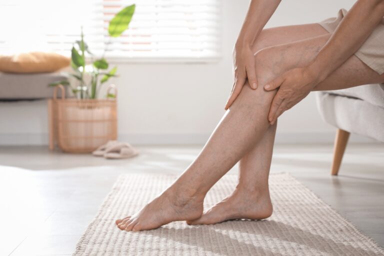 Close up of a patient's legs with dark varicose veins on the back of the knees, in need of treatment.